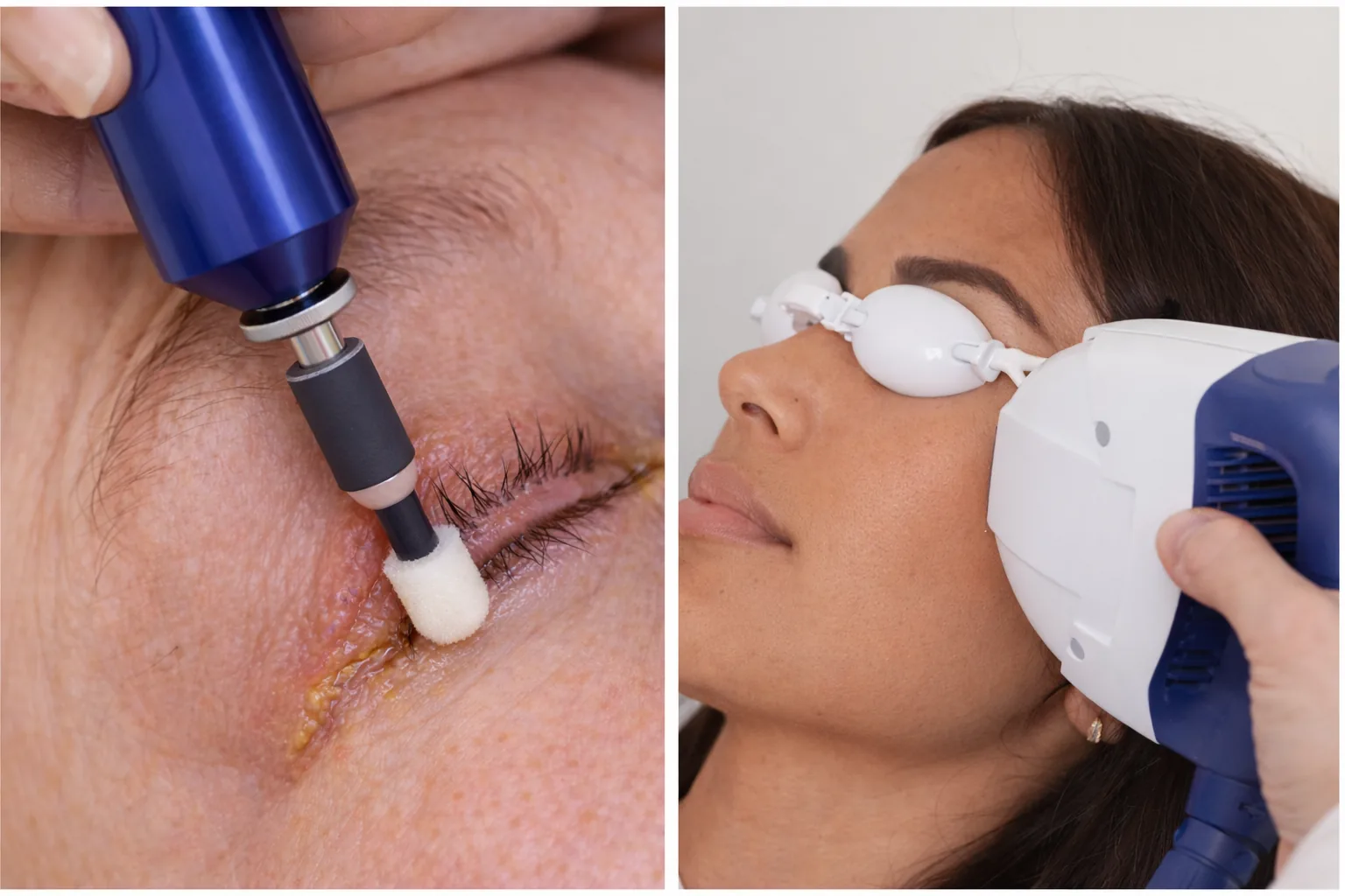 BlephEx vs IPL for Blepharitis: Which Targets Your Symptoms?