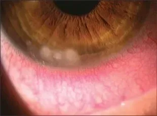 Diagram of a small white corneal infiltrate near the eyelid margin.