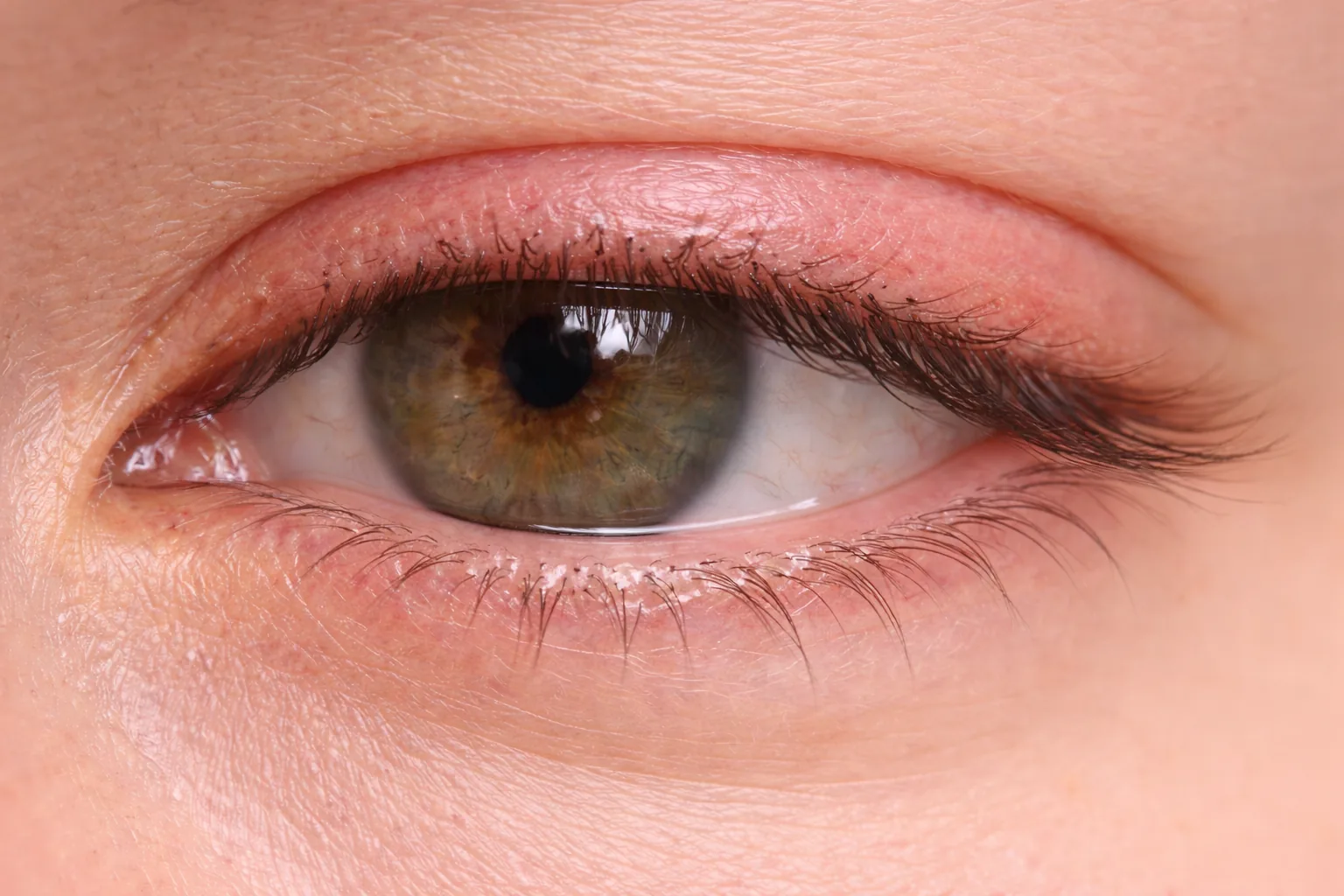 Blepharitis Symptoms & Diagnosis (UK): Where to Start